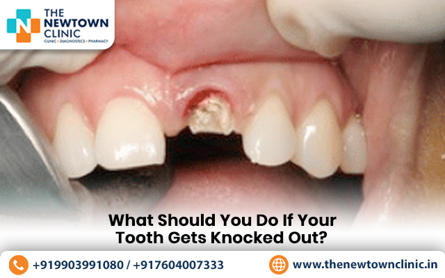 What Should You Do If Your Tooth Gets Knocked Out?