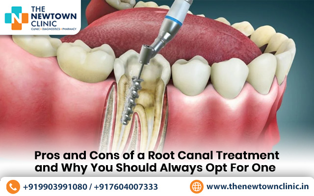 Pros and Cons of a Root Canal Treatment and Why You Should Always Opt For One