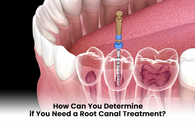 How Can You Determine if You Need a Root Canal Treatment?