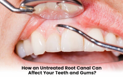 How an Untreated Root Canal Can Affect Your Teeth and Gums?