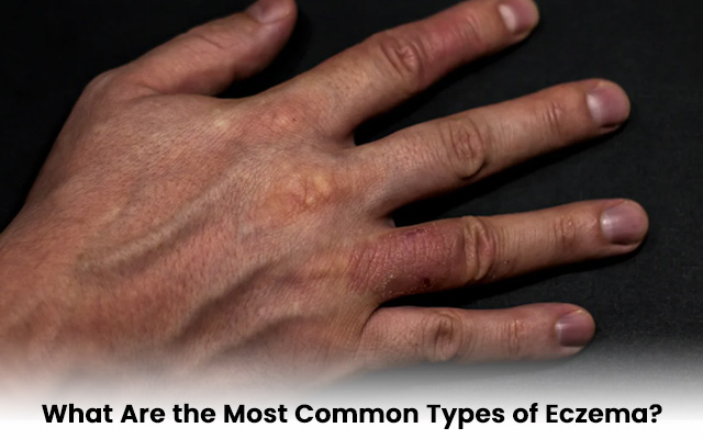 What Are the Most Common Types of Eczema?