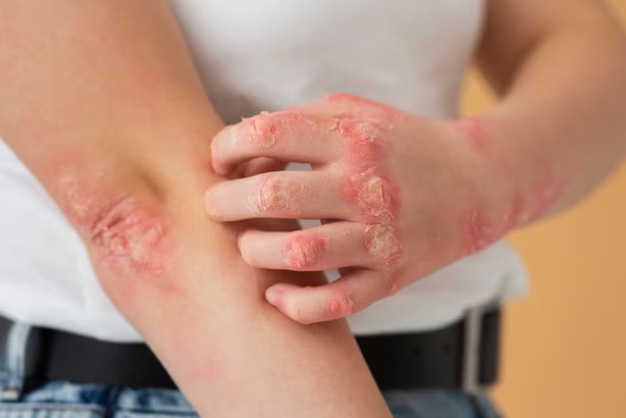 Bacterial or Fungal Skin Infections