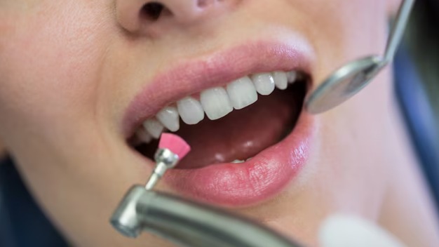 Professional Teeth Whitening Treatment