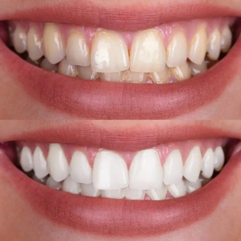 Teeth Whitening Before and After